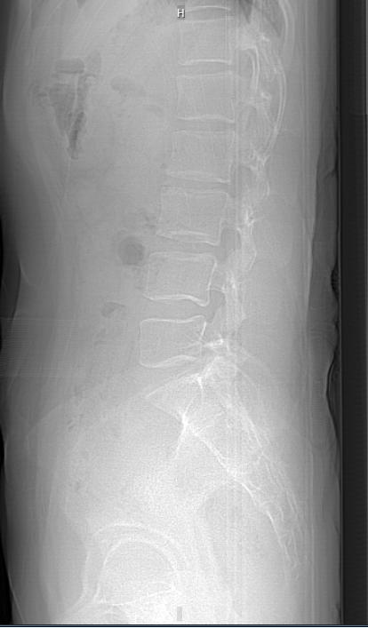 腰突压迫硬膜囊会出现什么症状,腰突压迫硬膜囊怎么恢复