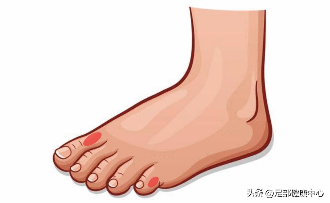 糖尿病患者需注意，新鞋磨脚可不是小问题，可能引发糖尿病足