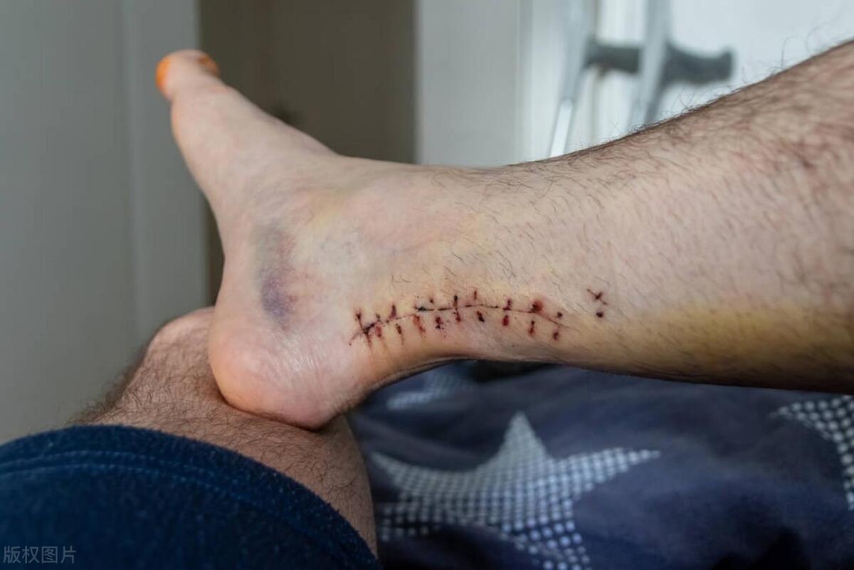 跟腱断裂对运动员的影响,运动员跟腱疼痛怎么解决