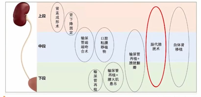 输尿管狭窄最好的手术方法,输尿管狭窄做尿结石微创手术步骤