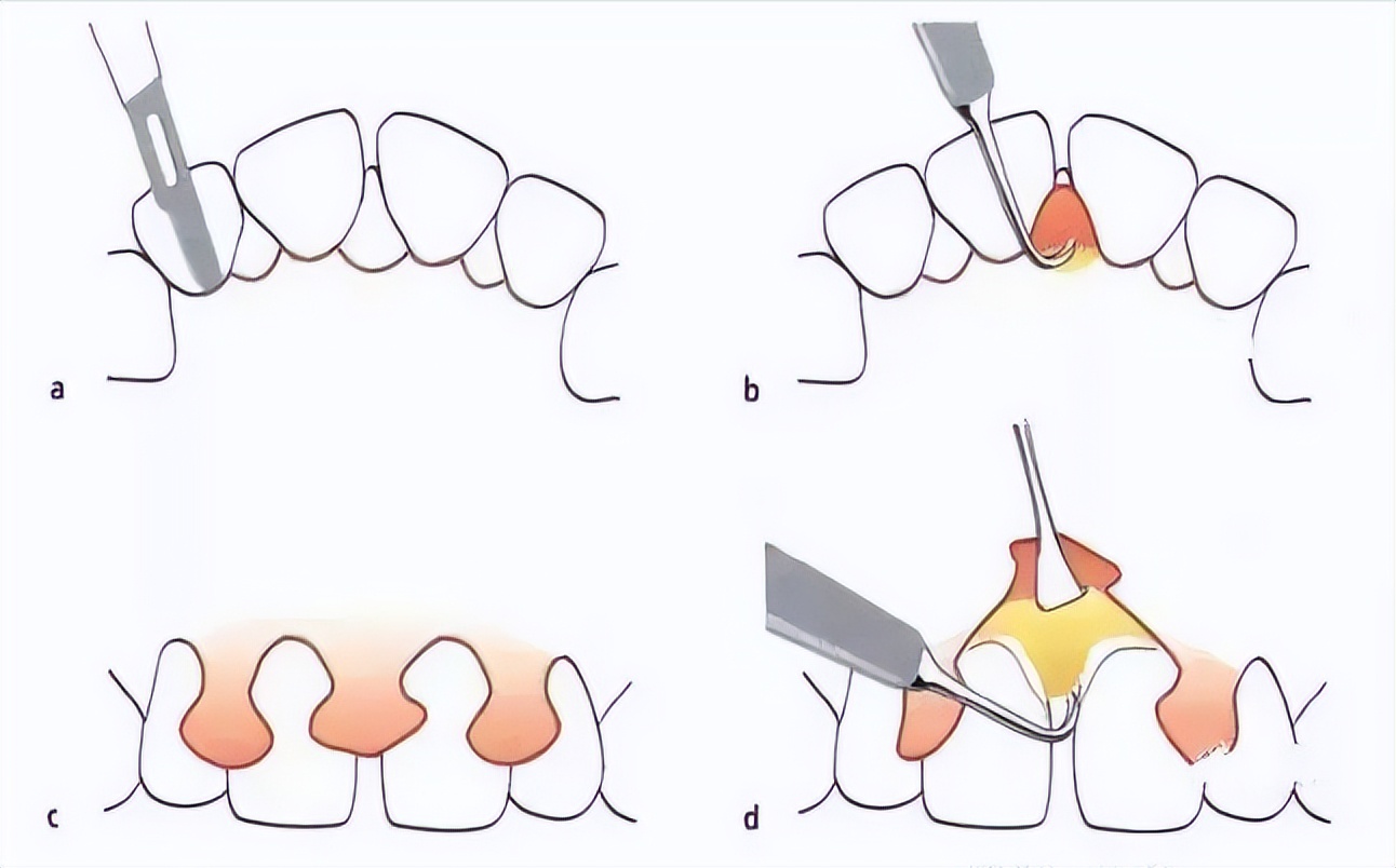 牙龈出血牙齿松动最佳补救方法,牙龈出血牙齿松动怎么办
