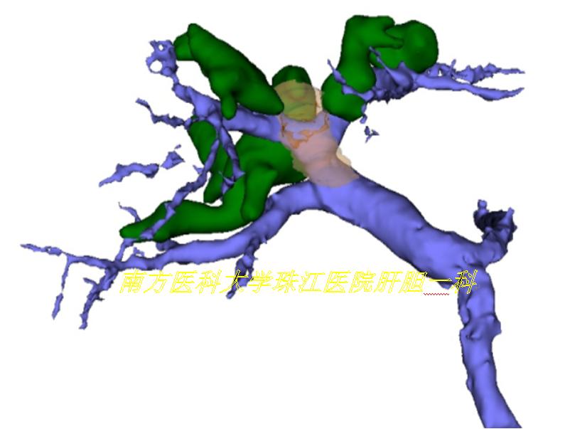 三维透视眼,透视眼治疗肿瘤