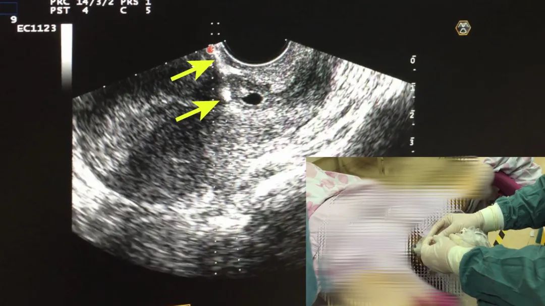 科普瘢痕修复重新缝合,瘢痕妊娠保守治疗成功率高吗