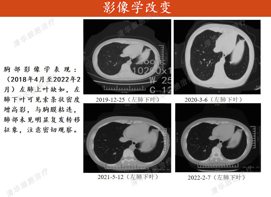 肺癌靶向疗法视频,肺癌靶向加免疫治疗方案