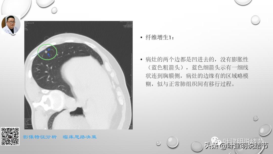 在《一脉阳光》呼吸影像诊断专题培训班上的讲课PPT（第一部分）