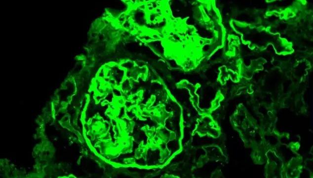 逆转肾病最新疗法,逆转肾脏纤维化