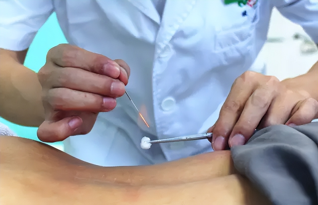 火针治疗皮肤病几天扎一次最好,健康科普皮肤健康知识分享