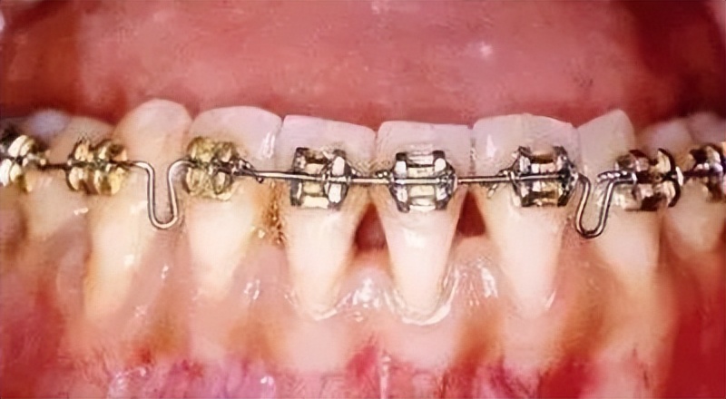 有牙周病可以做牙齿矫正吗,有牙周炎适合做牙齿矫正吗