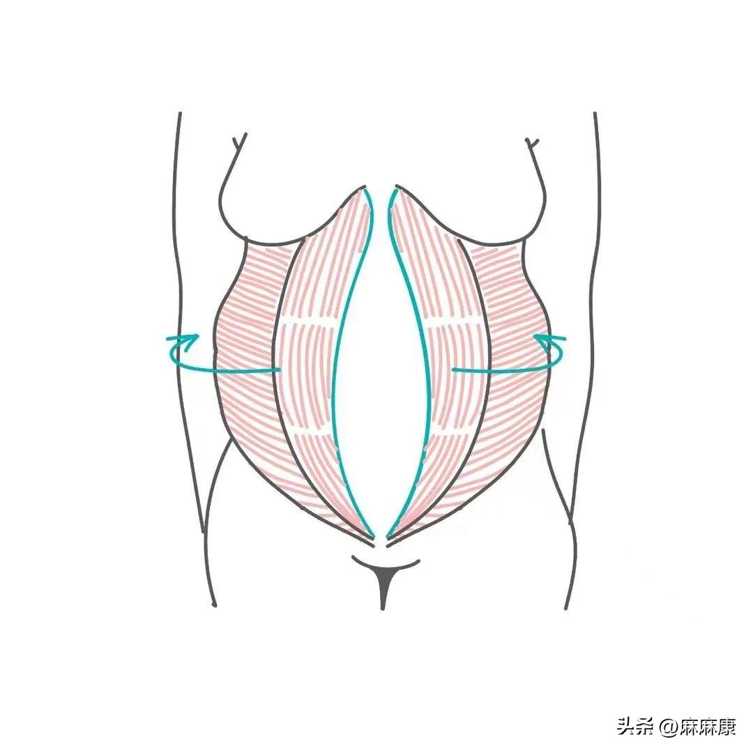 产后4年腹直肌如何恢复,产后腹直肌自己怎么修复