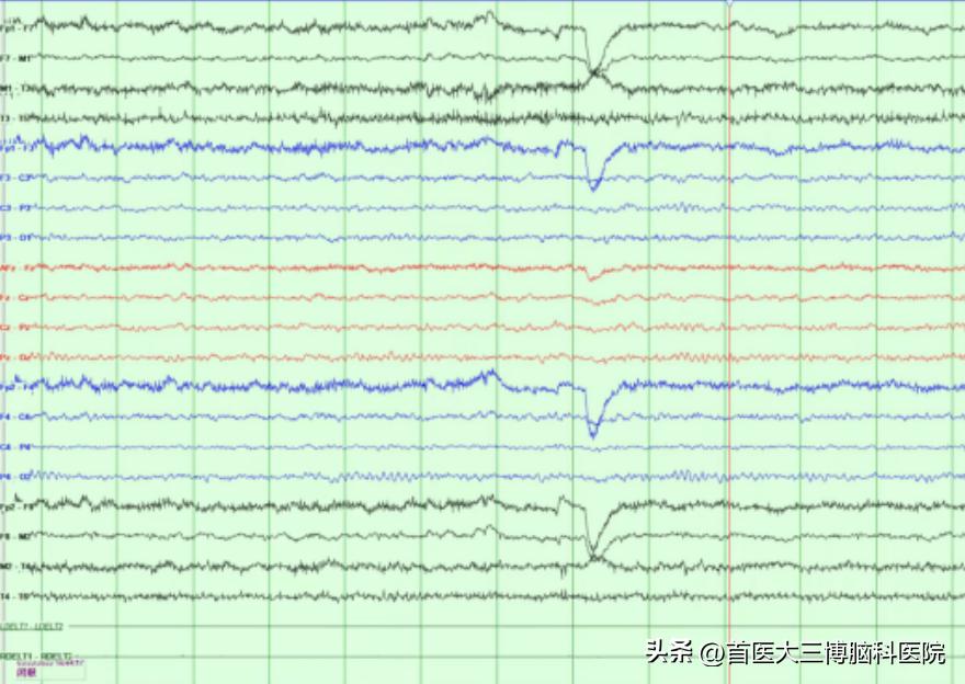 三博脑科医院脊髓外肿瘤手术,三博医院垂体瘤专家