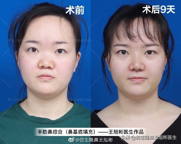 隆鼻太过于自然跟没做一样,隆鼻太自然和没做一样