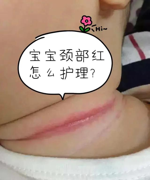 新生儿淹脖子发红怎么处理,宝宝淹脖子泛红涂什么最好