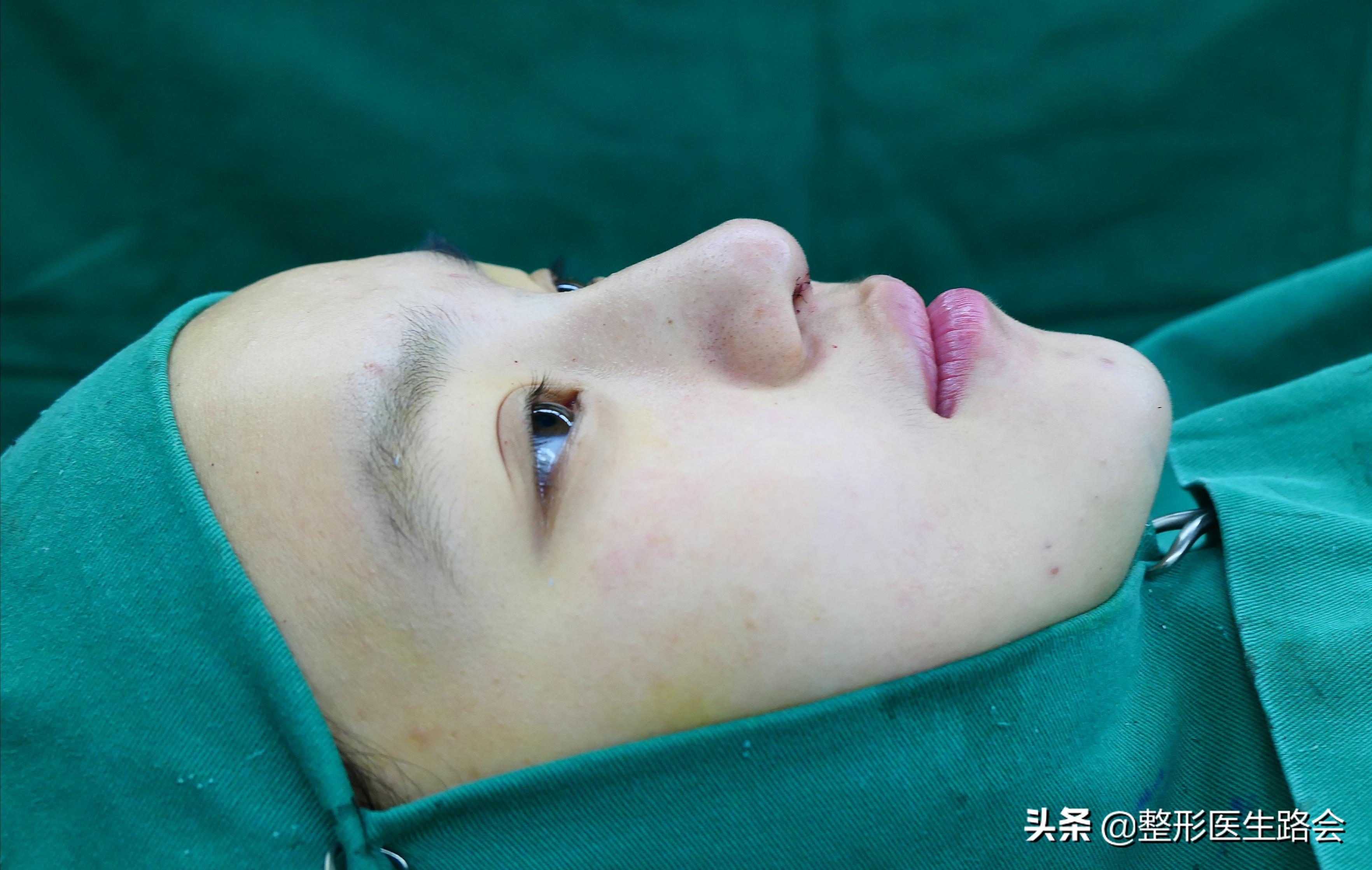 全脸整形记录恢复过程,女孩整形全过程