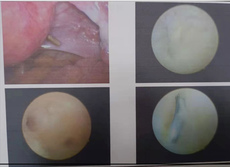 宫内节育环嵌顿彩超能看出来吗,宫内节育环副作用有哪些