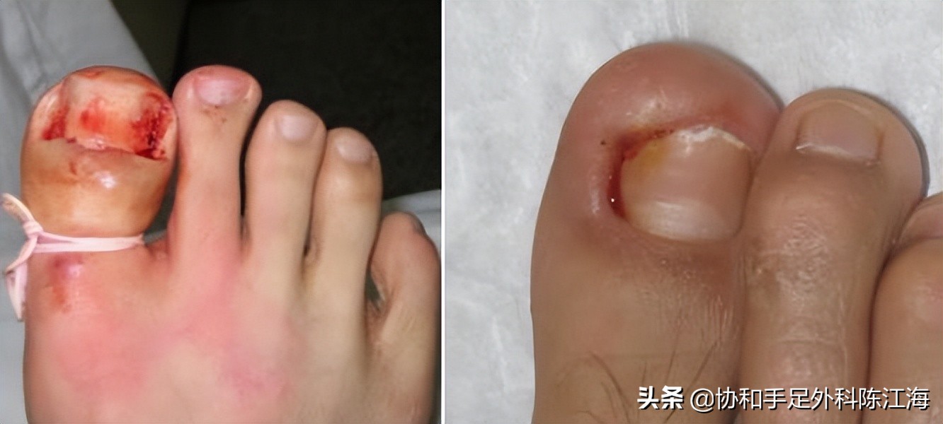 嵌甲炎拔甲还能长出来嘛,指甲根部嵌甲太深拔不出来怎么办