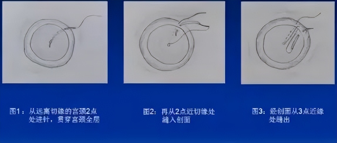 宫颈锥切手术后hpv会消除吗,宫颈锥切手术后多久可以做家务