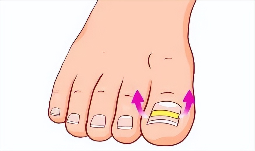 一走路脚趾甲痛,甲沟炎拔完脚趾甲很疼怎么办