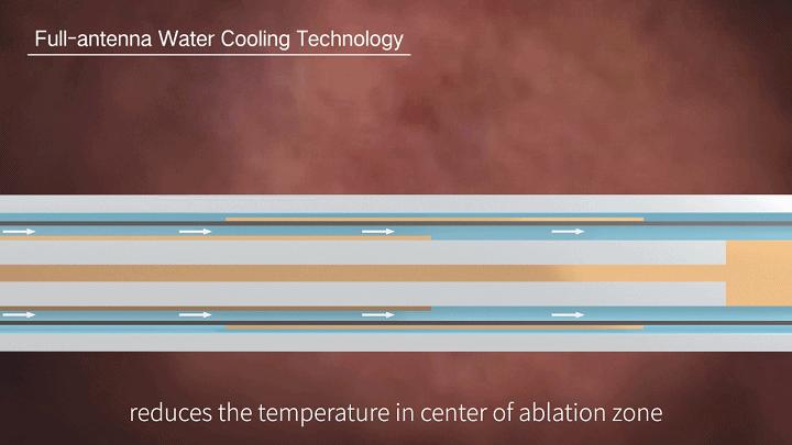 重磅|赛诺微Dophi®M150微波消融仪喜获国家药监局NMPA批准上市