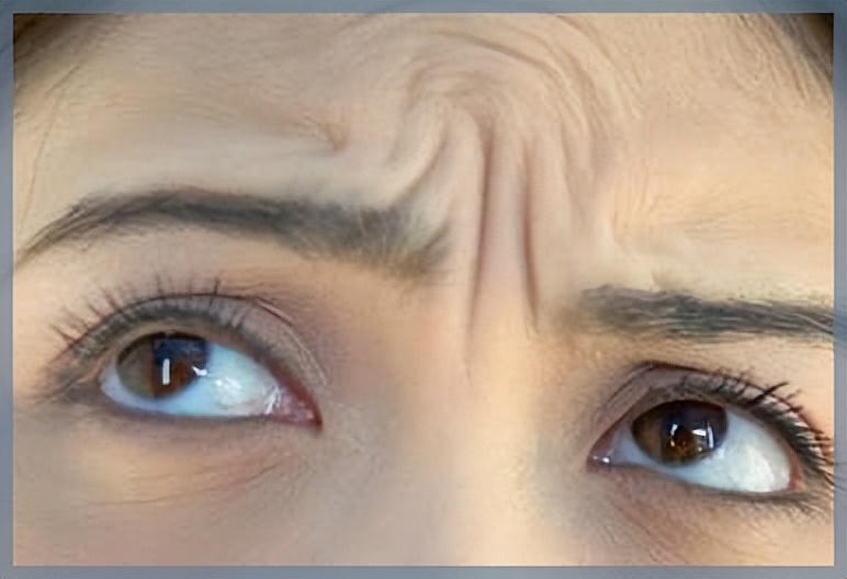 表情纹可以自然消除吗,表情纹怎么改善与预防