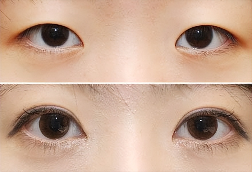 斜视的穴位治疗方法,斜视的最佳治疗方法是什么