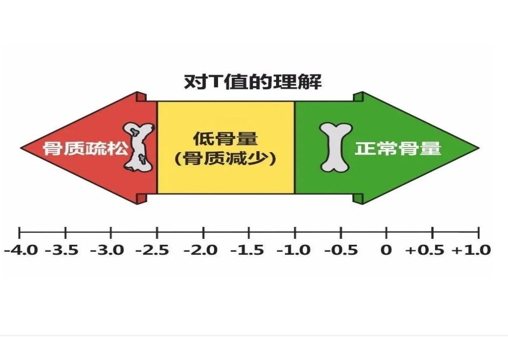 儿童骨密度检测中bmi正常范围,34岁骨密度检测说骨质疏松怎么办