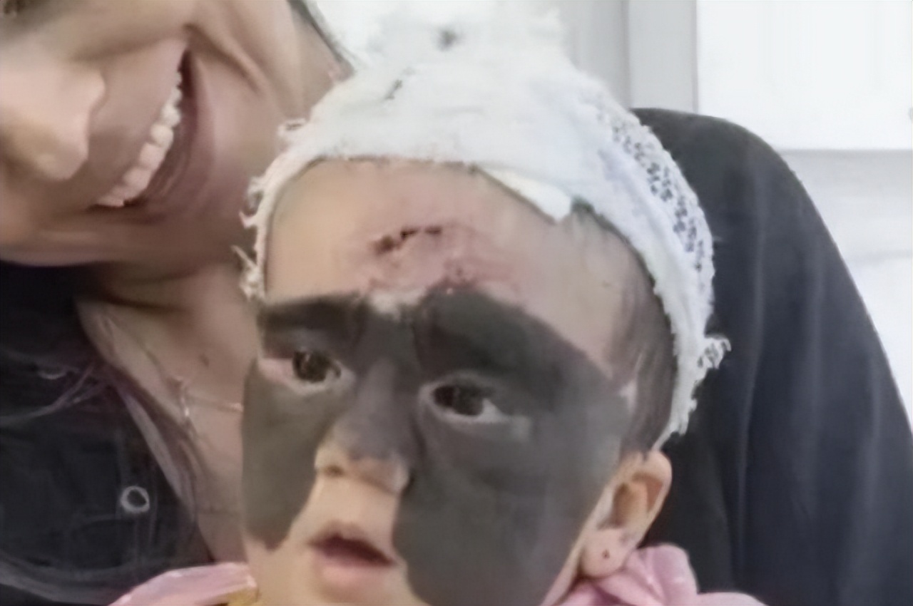 小女孩胎记后续,女童脸上长胎记去哪个医院