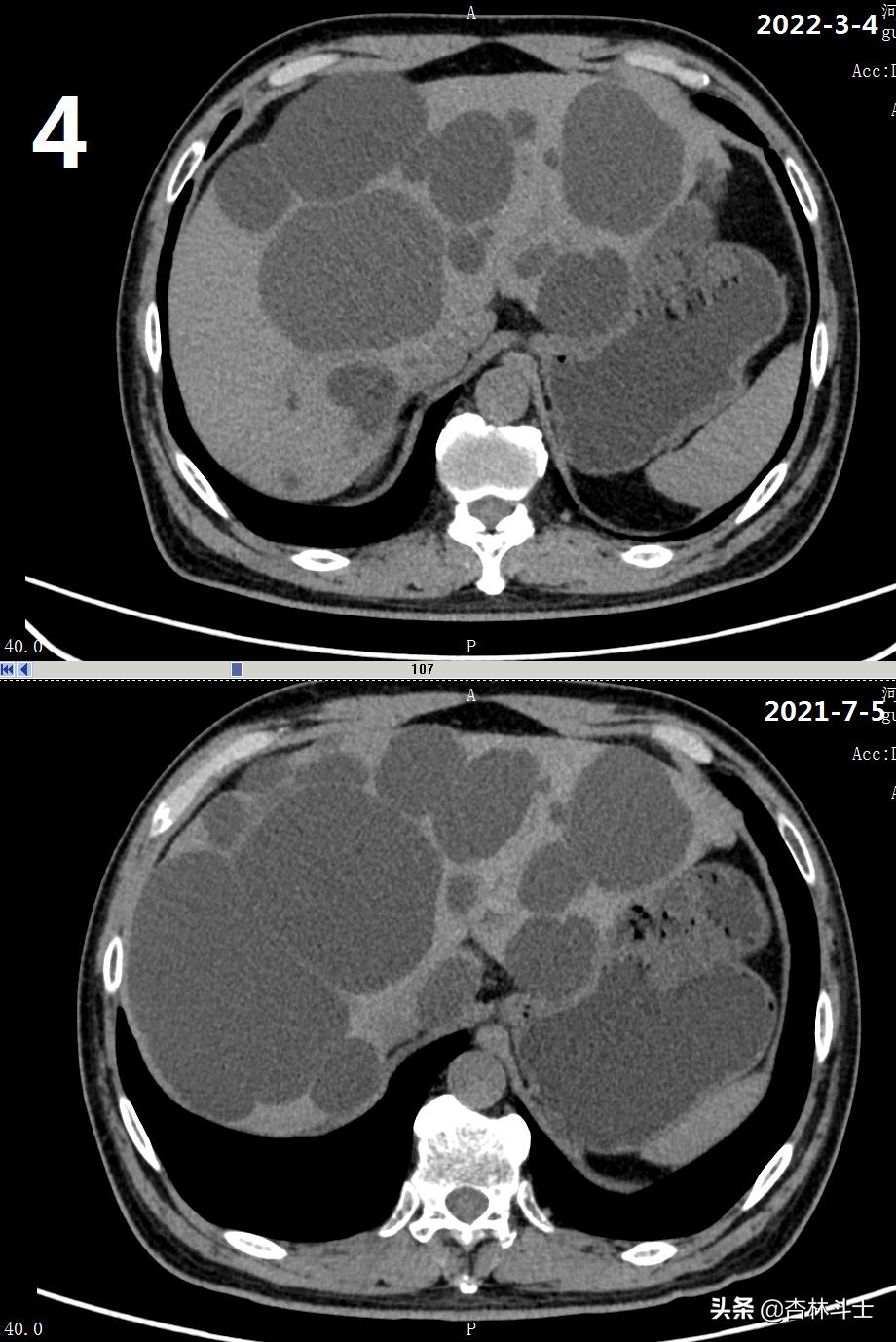 64岁银行职员患肝囊肿,CT引导下细针穿刺抽吸酒精硬化解决大问题