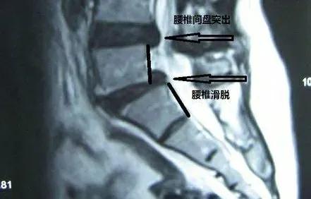 你的腰骨折过吗,你的腰椎