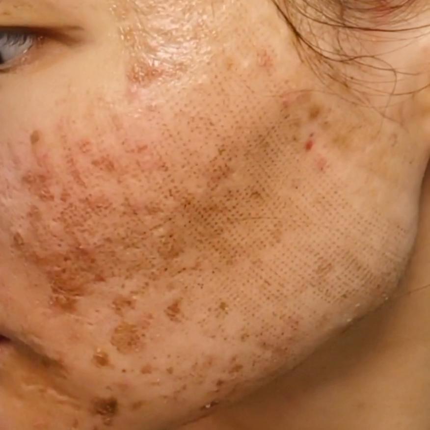 点阵激光后日常护理,点阵激光术后喷雾推荐