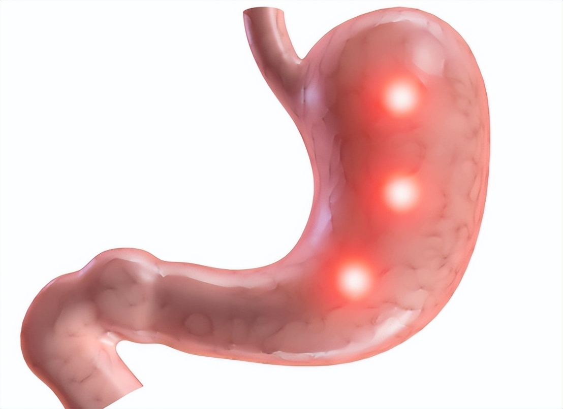 胃穿孔的症状及治疗方法,胃穿孔什么治疗方法好