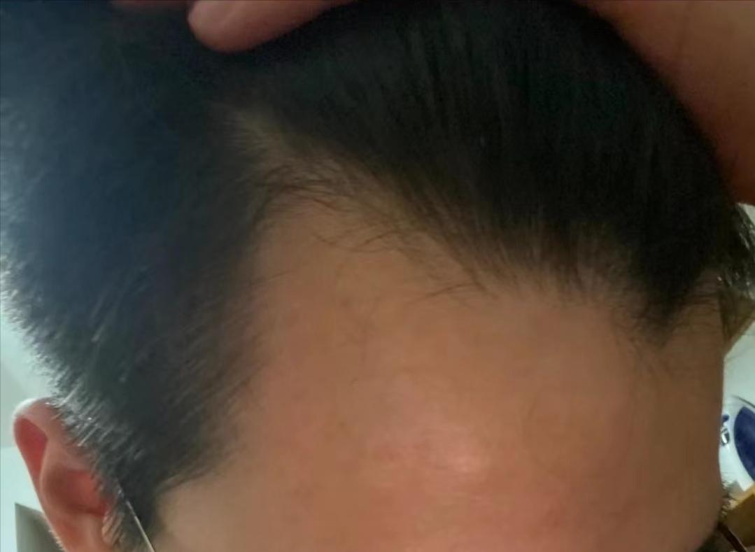 男生发际线秃,男生发际线秃适合剪什么头发