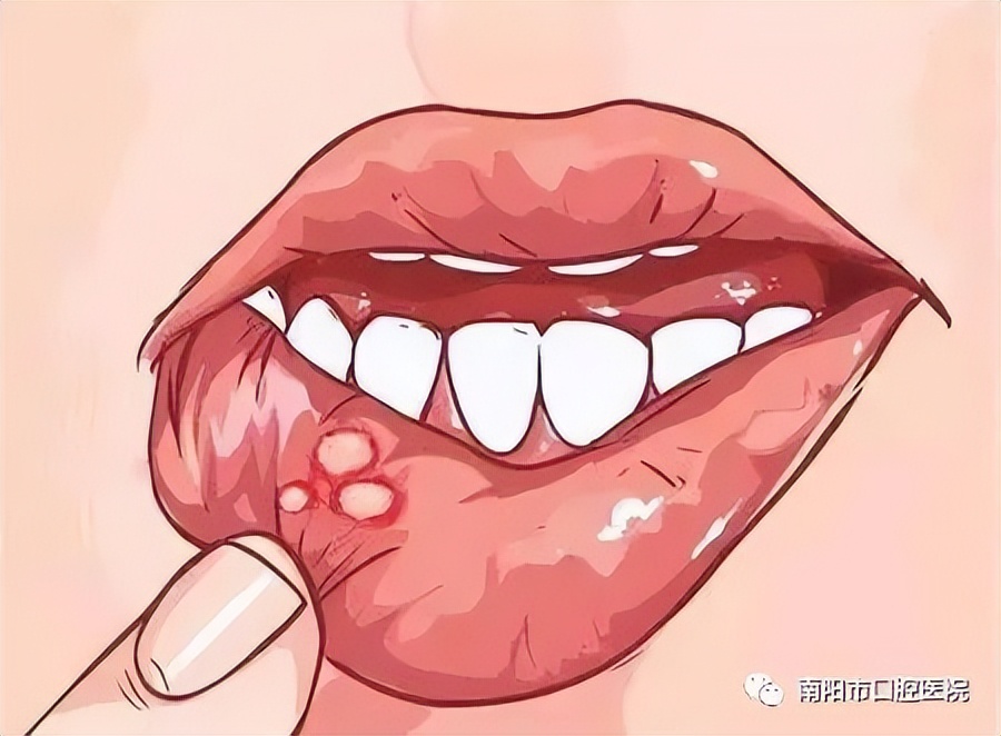 口腔里有白斑怎么治最快,口腔长了白斑怎么回事