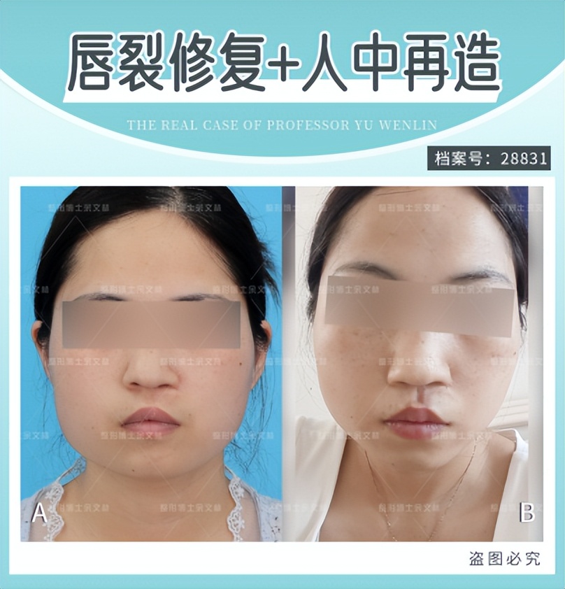 人中沟可以做出来吗,人中能整出来吗