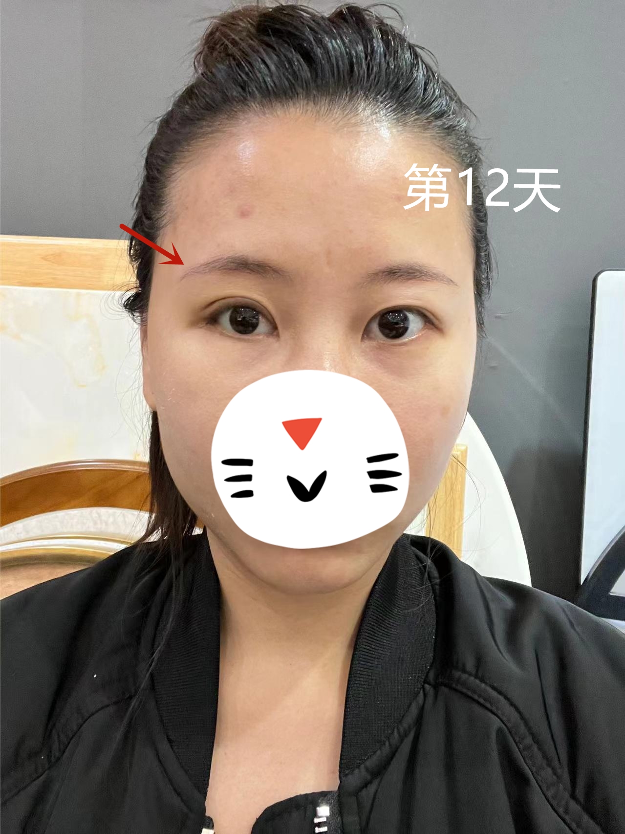 单眼上睑下垂恢复图,上眼睑下垂修复完大小眼明显