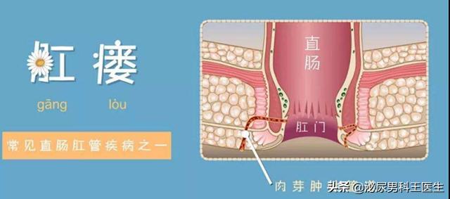 肛瘘不想做手术怎么保守治疗,为什么肛瘘手术后才是痛苦的开始