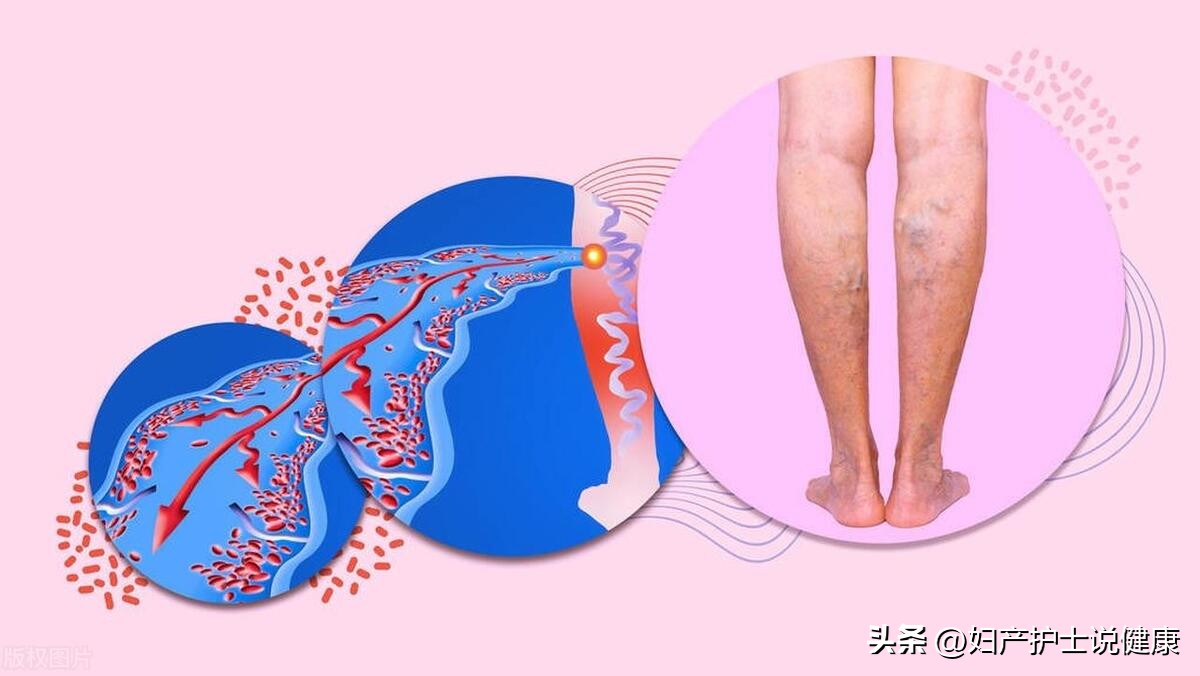 男人到底该不该穿长筒袜,做什么手术要穿弹力袜