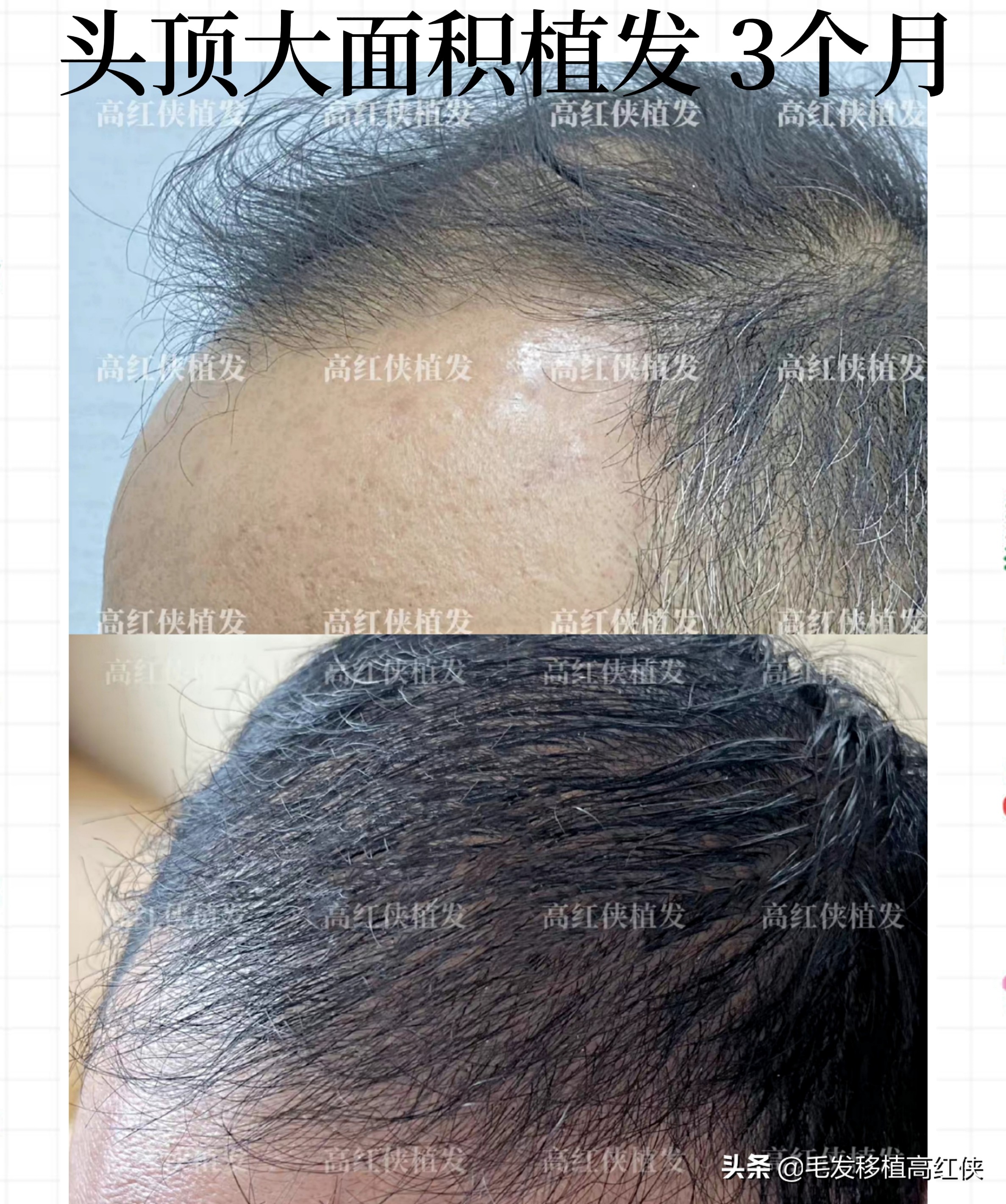 头顶大面积秃顶适合植发么,女生头顶秃顶植发