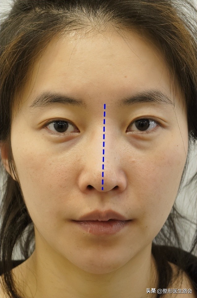 硅胶隆鼻恢复过程经历真实,我做了假体隆胸现在非常后悔