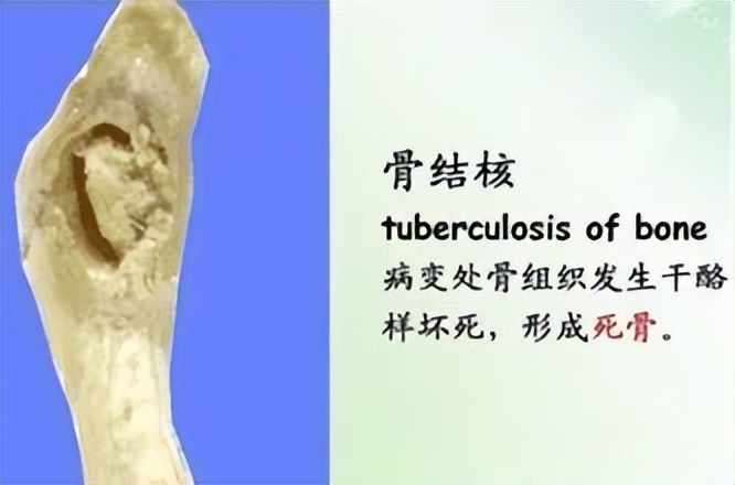 骨结核相关数据,骨结核病