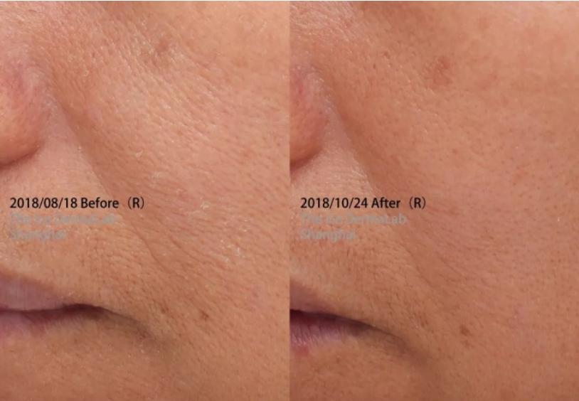 法令纹非常严重怎么消除,法令纹严重怎么处理比较好