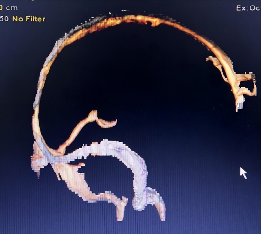 重症监护室救活孕妇故事,急救危急重症孕产妇途中分娩