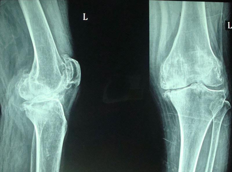 抬腿上楼梯时膝关节疼是怎么回事,上下楼梯膝关节疼痛是怎么回事