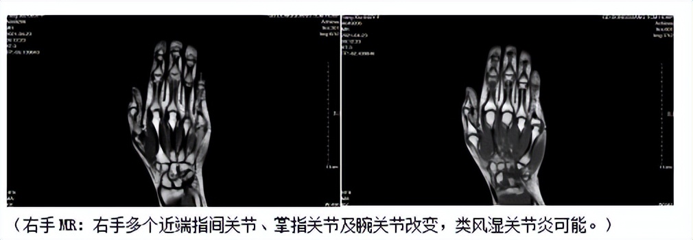 阿达木单抗治疗强直性脊柱炎案例,类风湿合并强直哪个药最好