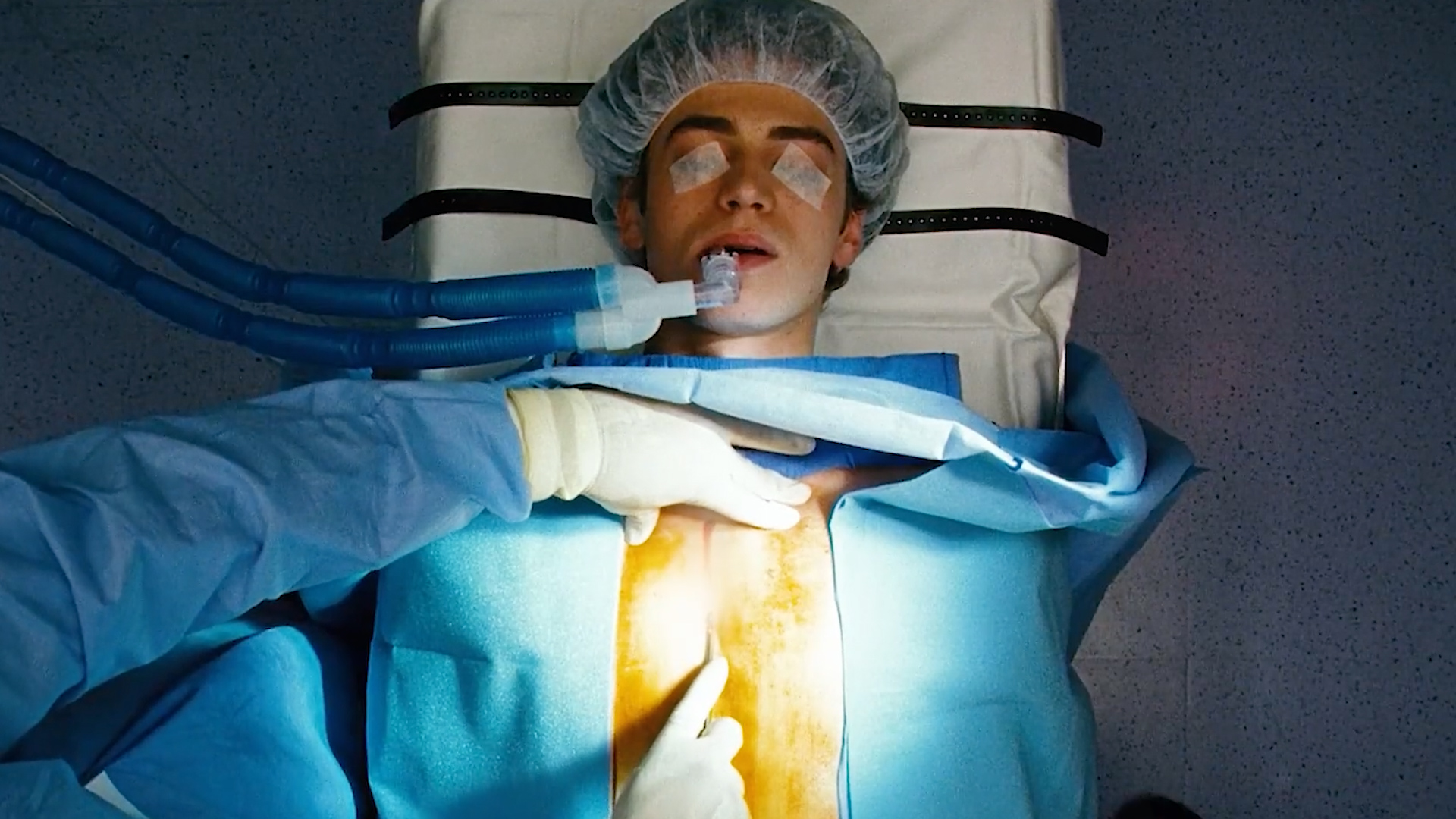 换瓣手术麻醉后遗症,换心手术并发症