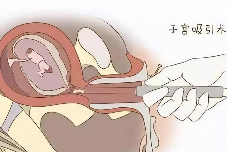 无痛人流真的没有疼痛感吗,无痛人流真的没有一点痛吗