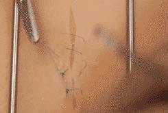 外科各种缝合方法的适用情况,外科操作缝合