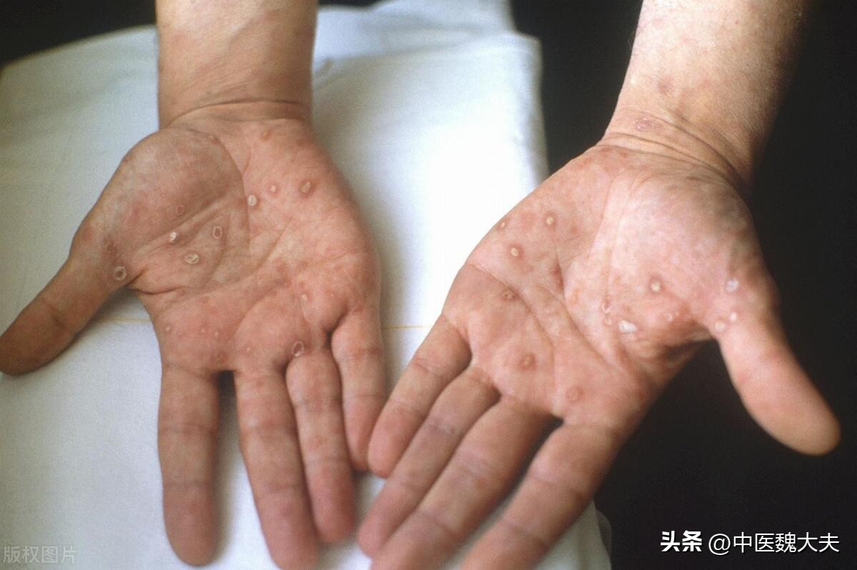 梅毒脚的这些典型表现!很多人却以为是脚气,白白耽误了病情