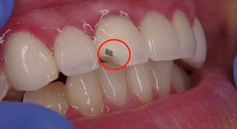 烤瓷牙什么情况要拆除,烤瓷牙崩瓷了要修复多少钱