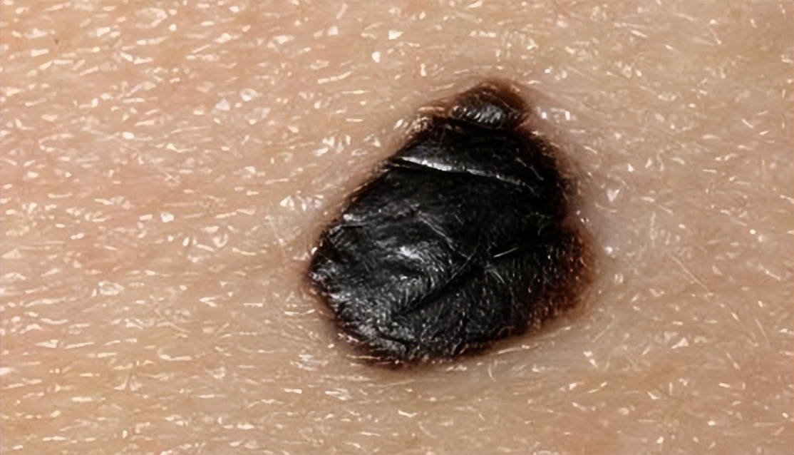 世卫组织公布「一级致癌物」名单,能不吃就不吃,别任性妄为!