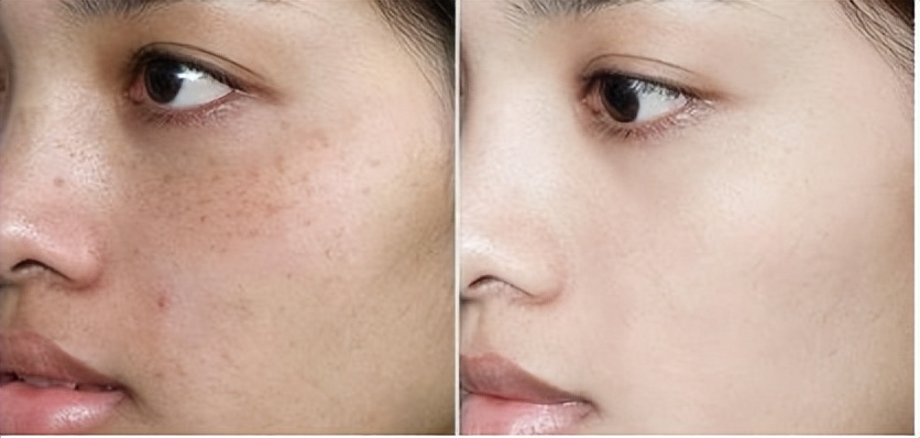 祛斑护肤品真的能祛斑吗,激光祛斑和护肤品祛斑哪个好